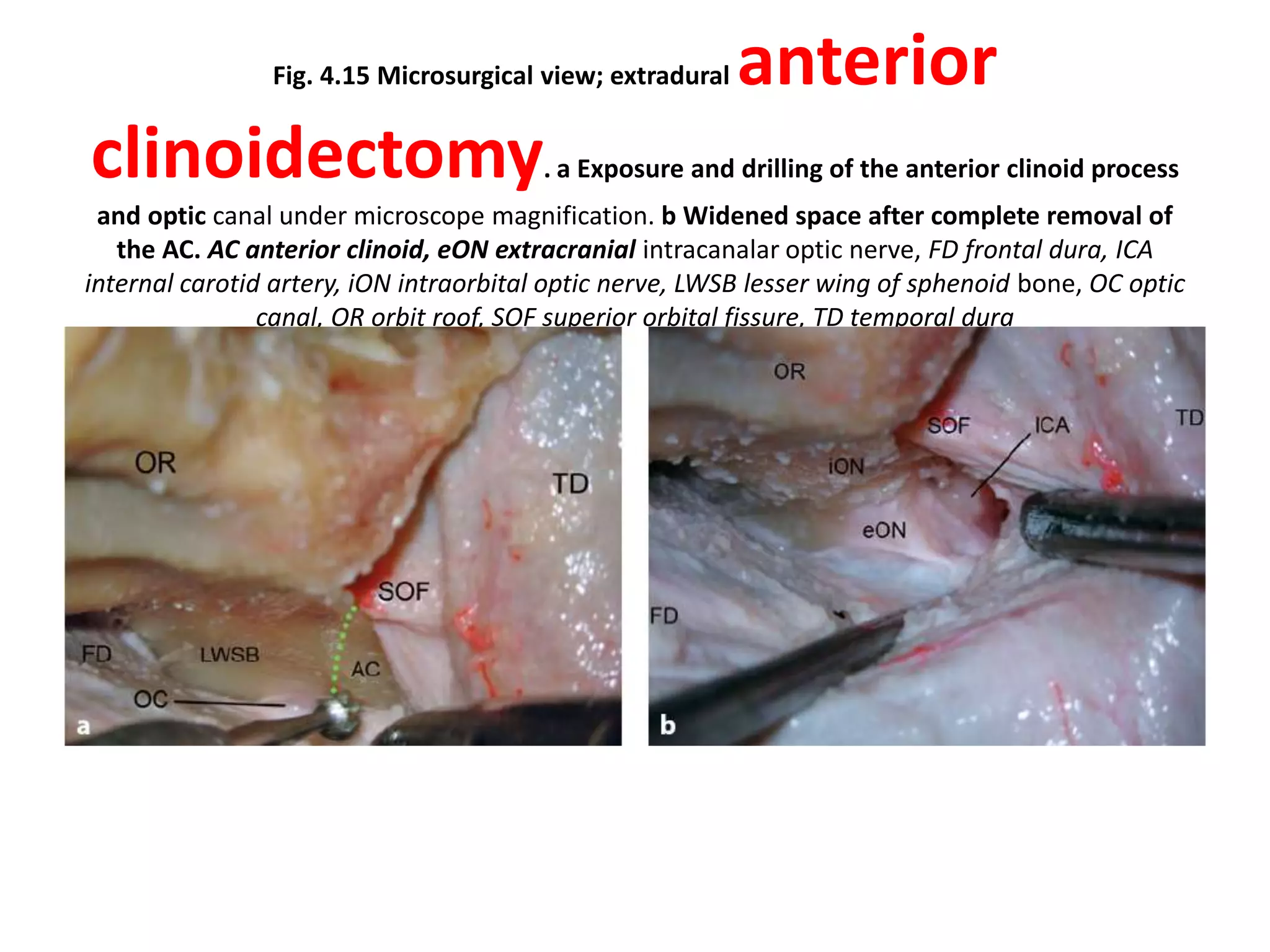 Fig. 4.15 Microsurgical view; extradural anterior
clinoidectomy. a Exposure and drilling of the anterior clinoid process
and optic canal under microscope magnification. b Widened space after complete removal of
the AC. AC anterior clinoid, eON extracranial intracanalar optic nerve, FD frontal dura, ICA
internal carotid artery, iON intraorbital optic nerve, LWSB lesser wing of sphenoid bone, OC optic
canal, OR orbit roof, SOF superior orbital fissure, TD temporal dura
 
