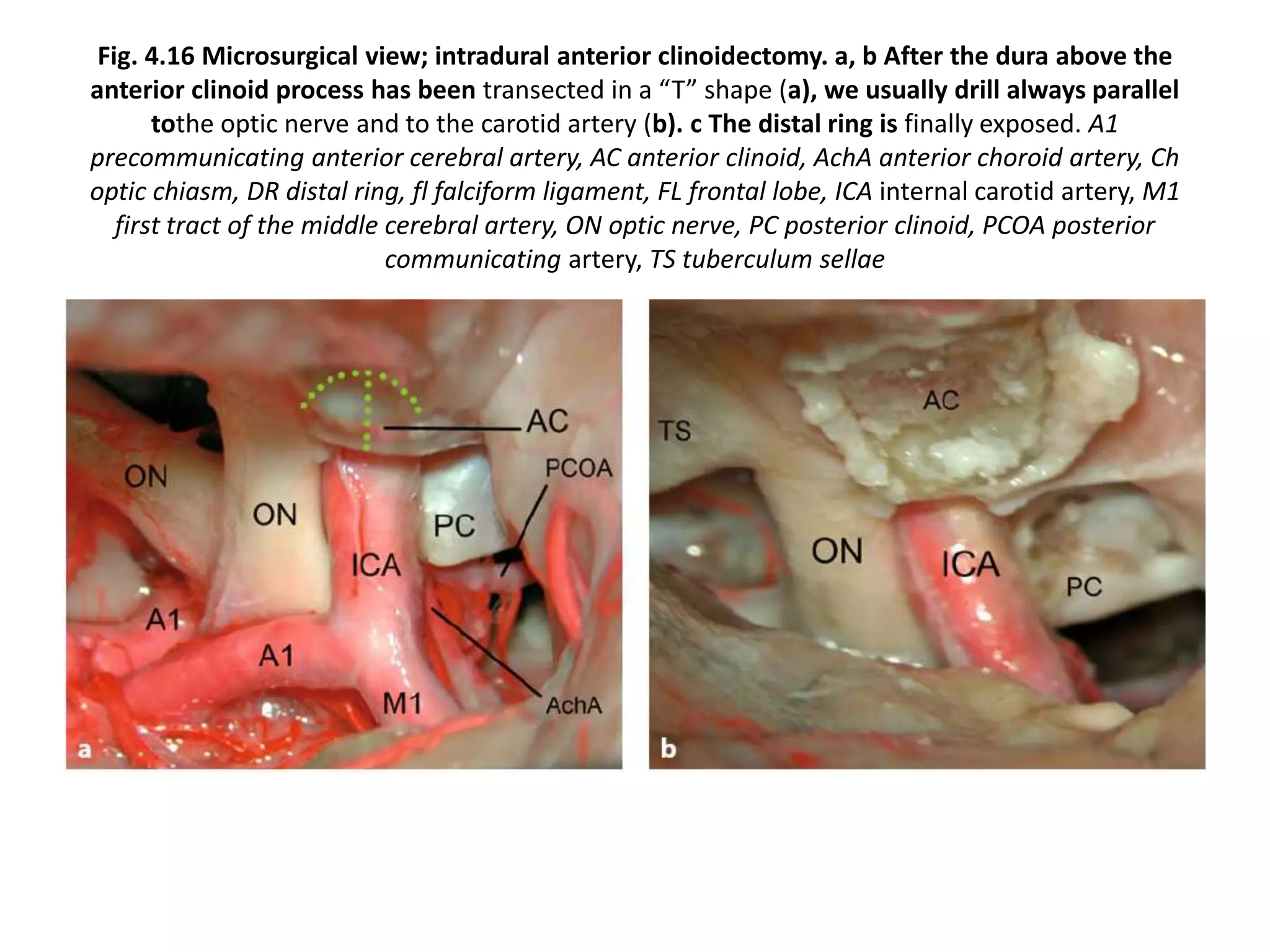 Fig. 4.16 Microsurgical view; intradural anterior clinoidectomy. a, b After the dura above the
anterior clinoid process has been transected in a “T” shape (a), we usually drill always parallel
tothe optic nerve and to the carotid artery (b). c The distal ring is finally exposed. A1
precommunicating anterior cerebral artery, AC anterior clinoid, AchA anterior choroid artery, Ch
optic chiasm, DR distal ring, fl falciform ligament, FL frontal lobe, ICA internal carotid artery, M1
first tract of the middle cerebral artery, ON optic nerve, PC posterior clinoid, PCOA posterior
communicating artery, TS tuberculum sellae
 