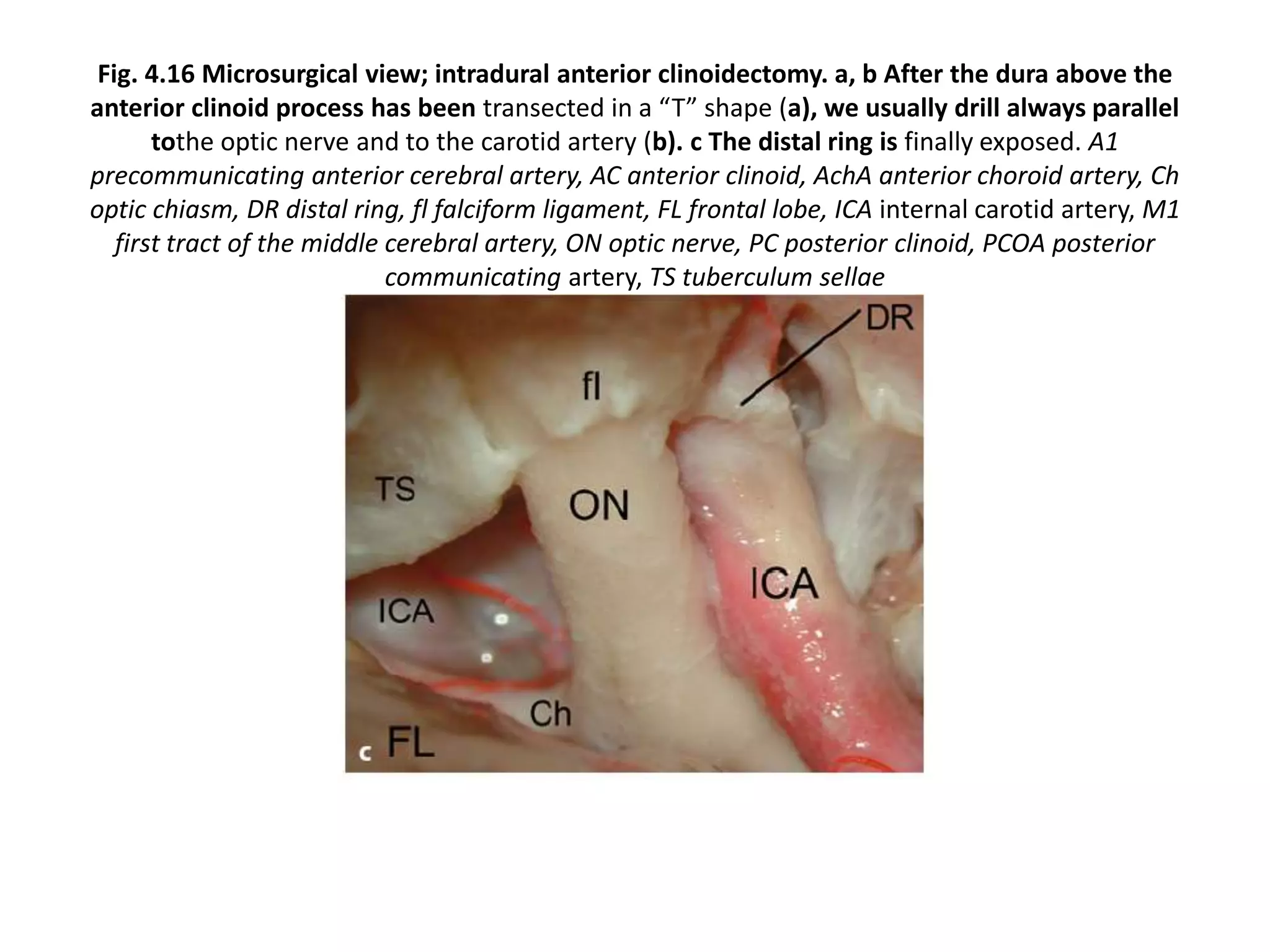 Fig. 4.16 Microsurgical view; intradural anterior clinoidectomy. a, b After the dura above the
anterior clinoid process has been transected in a “T” shape (a), we usually drill always parallel
tothe optic nerve and to the carotid artery (b). c The distal ring is finally exposed. A1
precommunicating anterior cerebral artery, AC anterior clinoid, AchA anterior choroid artery, Ch
optic chiasm, DR distal ring, fl falciform ligament, FL frontal lobe, ICA internal carotid artery, M1
first tract of the middle cerebral artery, ON optic nerve, PC posterior clinoid, PCOA posterior
communicating artery, TS tuberculum sellae
 
