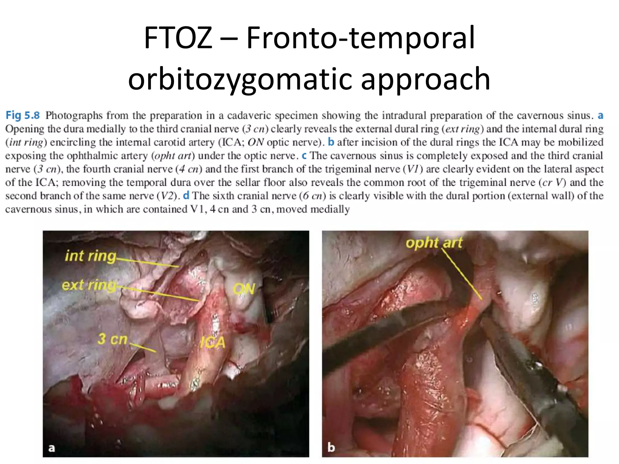FTOZ – Fronto-temporal
orbitozygomatic approach
 