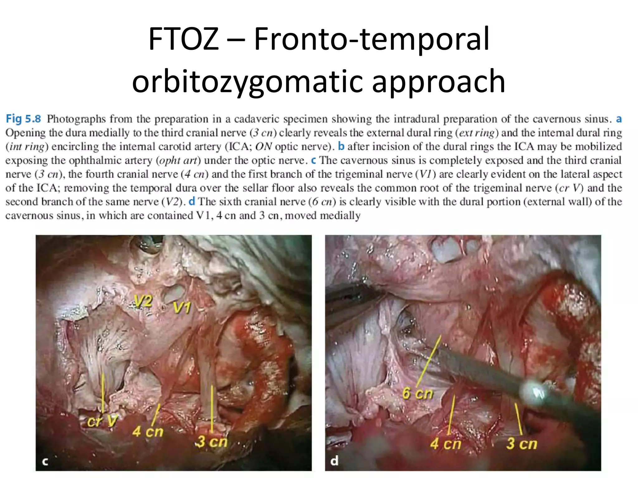 FTOZ – Fronto-temporal
orbitozygomatic approach
 