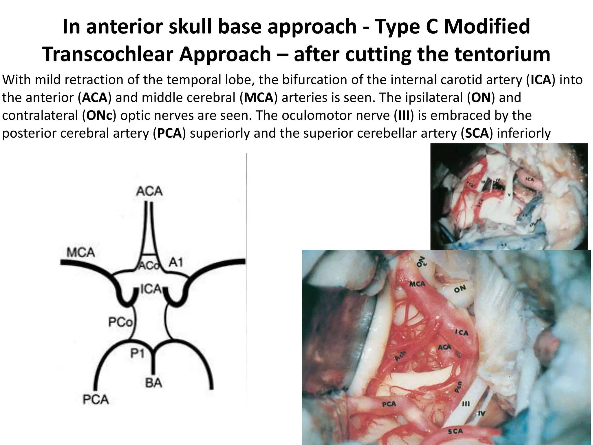 In anterior skull base approach - Type C Modified
Transcochlear Approach – after cutting the tentorium
With mild retraction of the temporal lobe, the bifurcation of the internal carotid artery (ICA) into
the anterior (ACA) and middle cerebral (MCA) arteries is seen. The ipsilateral (ON) and
contralateral (ONc) optic nerves are seen. The oculomotor nerve (III) is embraced by the
posterior cerebral artery (PCA) superiorly and the superior cerebellar artery (SCA) inferiorly
 