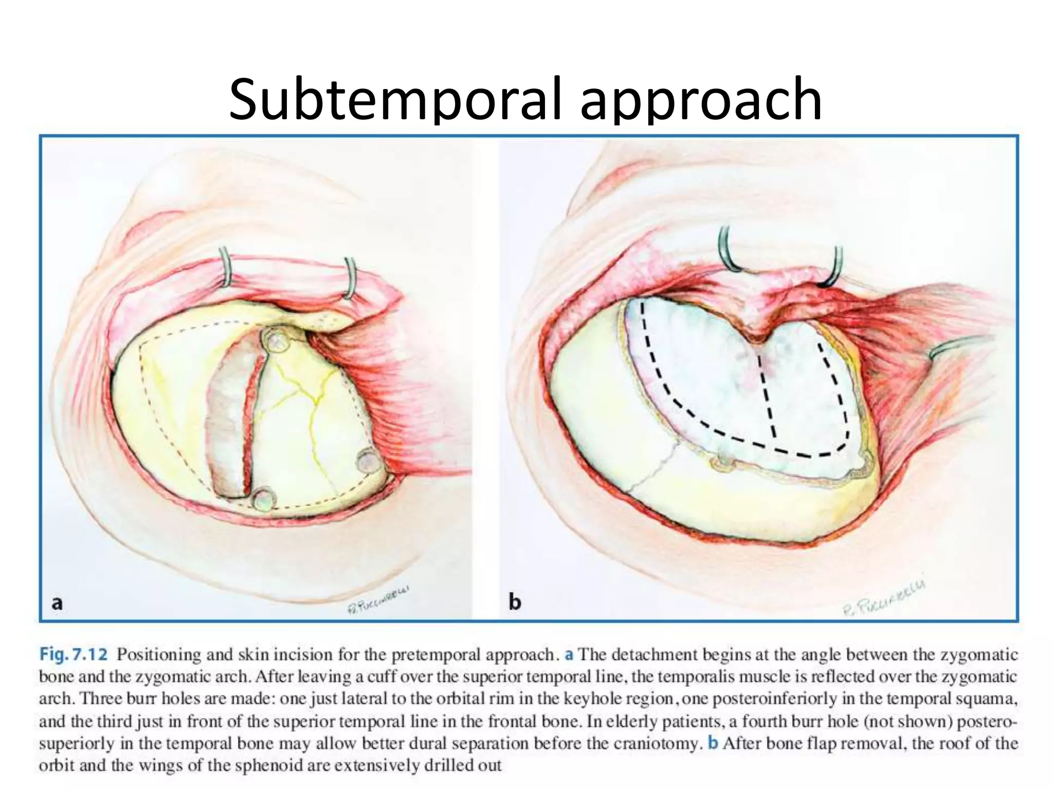 Subtemporal approach
 