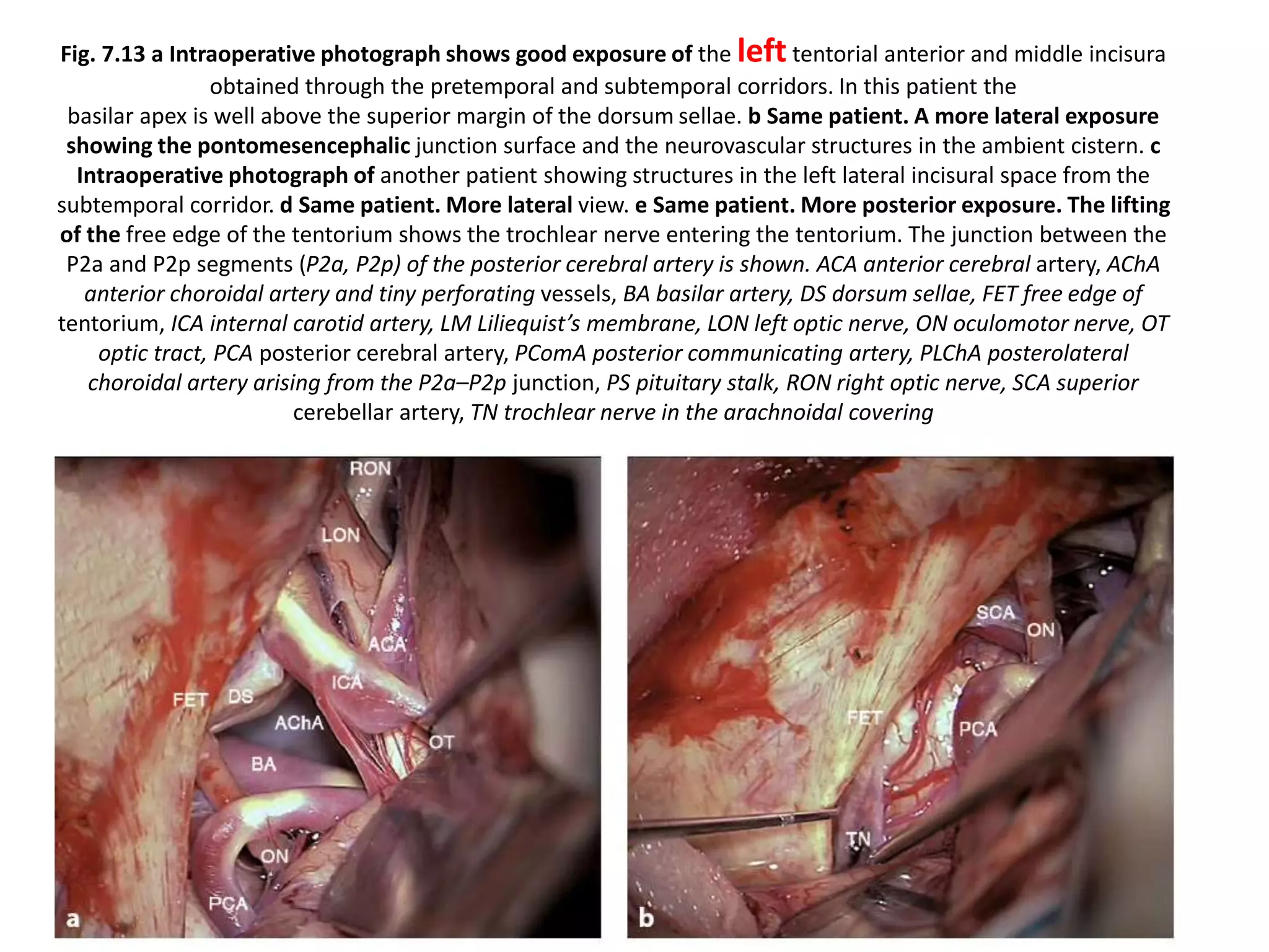Fig. 7.13 a Intraoperative photograph shows good exposure of the left tentorial anterior and middle incisura
obtained through the pretemporal and subtemporal corridors. In this patient the
basilar apex is well above the superior margin of the dorsum sellae. b Same patient. A more lateral exposure
showing the pontomesencephalic junction surface and the neurovascular structures in the ambient cistern. c
Intraoperative photograph of another patient showing structures in the left lateral incisural space from the
subtemporal corridor. d Same patient. More lateral view. e Same patient. More posterior exposure. The lifting
of the free edge of the tentorium shows the trochlear nerve entering the tentorium. The junction between the
P2a and P2p segments (P2a, P2p) of the posterior cerebral artery is shown. ACA anterior cerebral artery, AChA
anterior choroidal artery and tiny perforating vessels, BA basilar artery, DS dorsum sellae, FET free edge of
tentorium, ICA internal carotid artery, LM Liliequist’s membrane, LON left optic nerve, ON oculomotor nerve, OT
optic tract, PCA posterior cerebral artery, PComA posterior communicating artery, PLChA posterolateral
choroidal artery arising from the P2a–P2p junction, PS pituitary stalk, RON right optic nerve, SCA superior
cerebellar artery, TN trochlear nerve in the arachnoidal covering
 