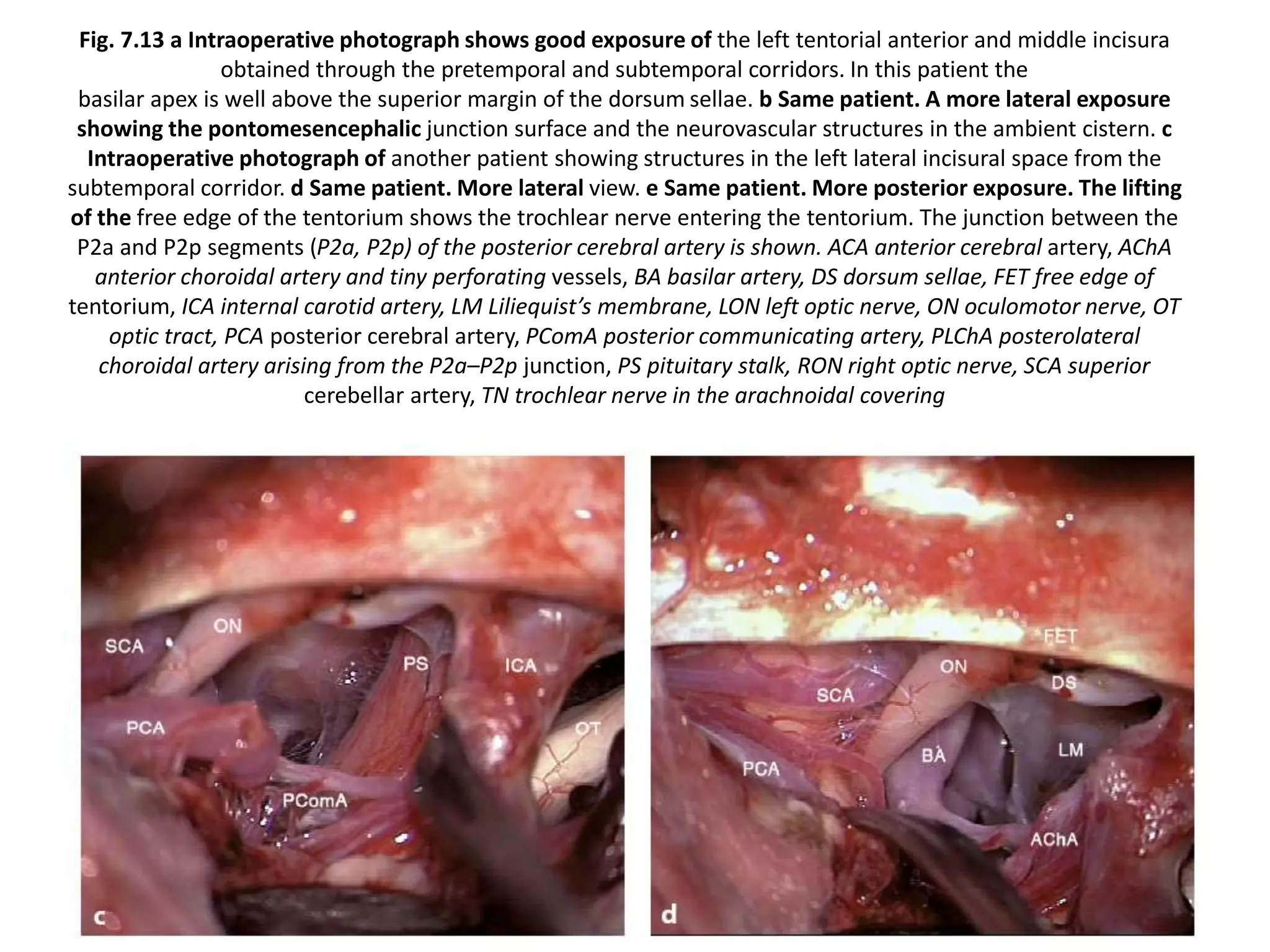 Fig. 7.13 a Intraoperative photograph shows good exposure of the left tentorial anterior and middle incisura
obtained through the pretemporal and subtemporal corridors. In this patient the
basilar apex is well above the superior margin of the dorsum sellae. b Same patient. A more lateral exposure
showing the pontomesencephalic junction surface and the neurovascular structures in the ambient cistern. c
Intraoperative photograph of another patient showing structures in the left lateral incisural space from the
subtemporal corridor. d Same patient. More lateral view. e Same patient. More posterior exposure. The lifting
of the free edge of the tentorium shows the trochlear nerve entering the tentorium. The junction between the
P2a and P2p segments (P2a, P2p) of the posterior cerebral artery is shown. ACA anterior cerebral artery, AChA
anterior choroidal artery and tiny perforating vessels, BA basilar artery, DS dorsum sellae, FET free edge of
tentorium, ICA internal carotid artery, LM Liliequist’s membrane, LON left optic nerve, ON oculomotor nerve, OT
optic tract, PCA posterior cerebral artery, PComA posterior communicating artery, PLChA posterolateral
choroidal artery arising from the P2a–P2p junction, PS pituitary stalk, RON right optic nerve, SCA superior
cerebellar artery, TN trochlear nerve in the arachnoidal covering
 