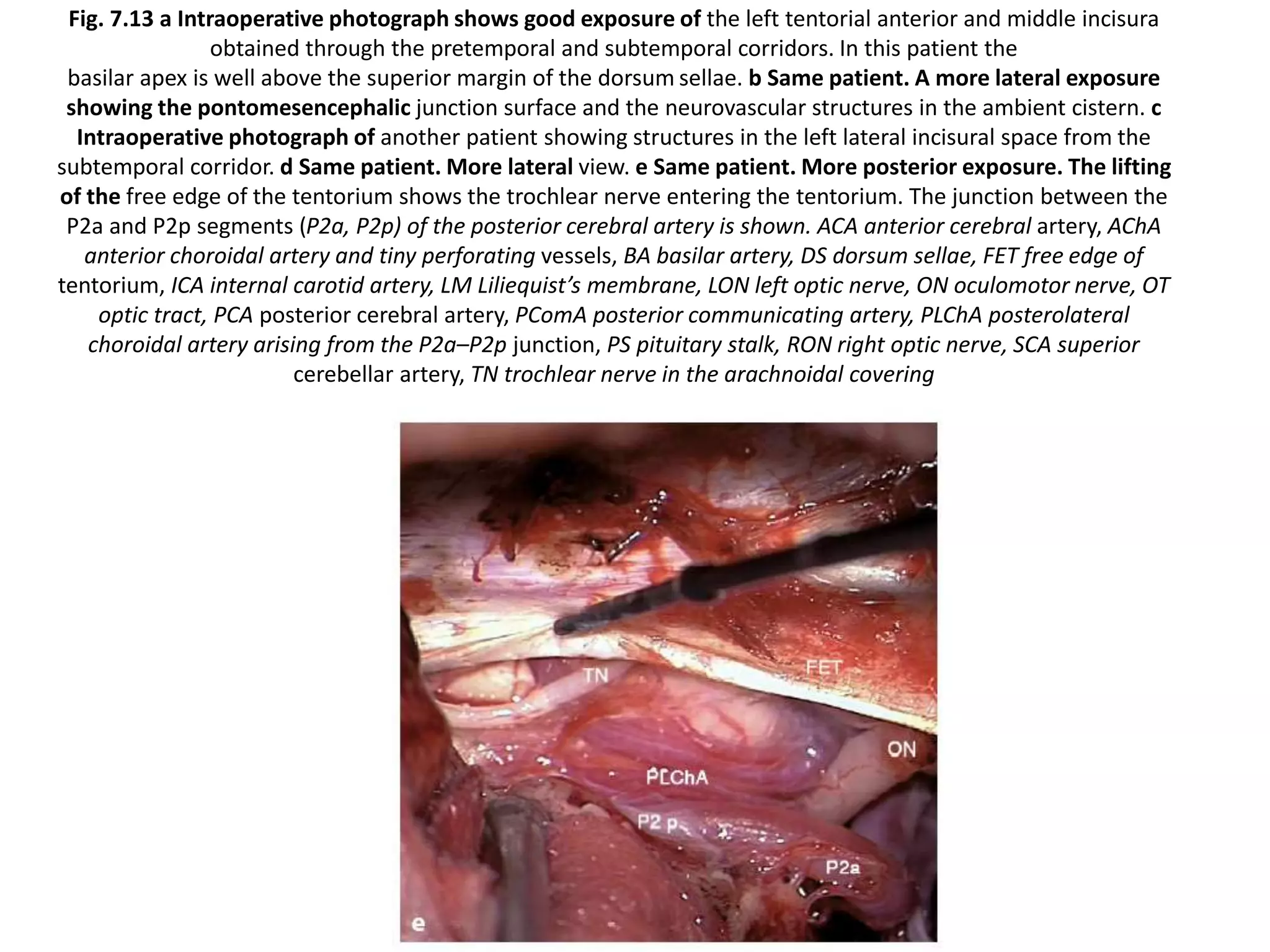 Fig. 7.13 a Intraoperative photograph shows good exposure of the left tentorial anterior and middle incisura
obtained through the pretemporal and subtemporal corridors. In this patient the
basilar apex is well above the superior margin of the dorsum sellae. b Same patient. A more lateral exposure
showing the pontomesencephalic junction surface and the neurovascular structures in the ambient cistern. c
Intraoperative photograph of another patient showing structures in the left lateral incisural space from the
subtemporal corridor. d Same patient. More lateral view. e Same patient. More posterior exposure. The lifting
of the free edge of the tentorium shows the trochlear nerve entering the tentorium. The junction between the
P2a and P2p segments (P2a, P2p) of the posterior cerebral artery is shown. ACA anterior cerebral artery, AChA
anterior choroidal artery and tiny perforating vessels, BA basilar artery, DS dorsum sellae, FET free edge of
tentorium, ICA internal carotid artery, LM Liliequist’s membrane, LON left optic nerve, ON oculomotor nerve, OT
optic tract, PCA posterior cerebral artery, PComA posterior communicating artery, PLChA posterolateral
choroidal artery arising from the P2a–P2p junction, PS pituitary stalk, RON right optic nerve, SCA superior
cerebellar artery, TN trochlear nerve in the arachnoidal covering
 