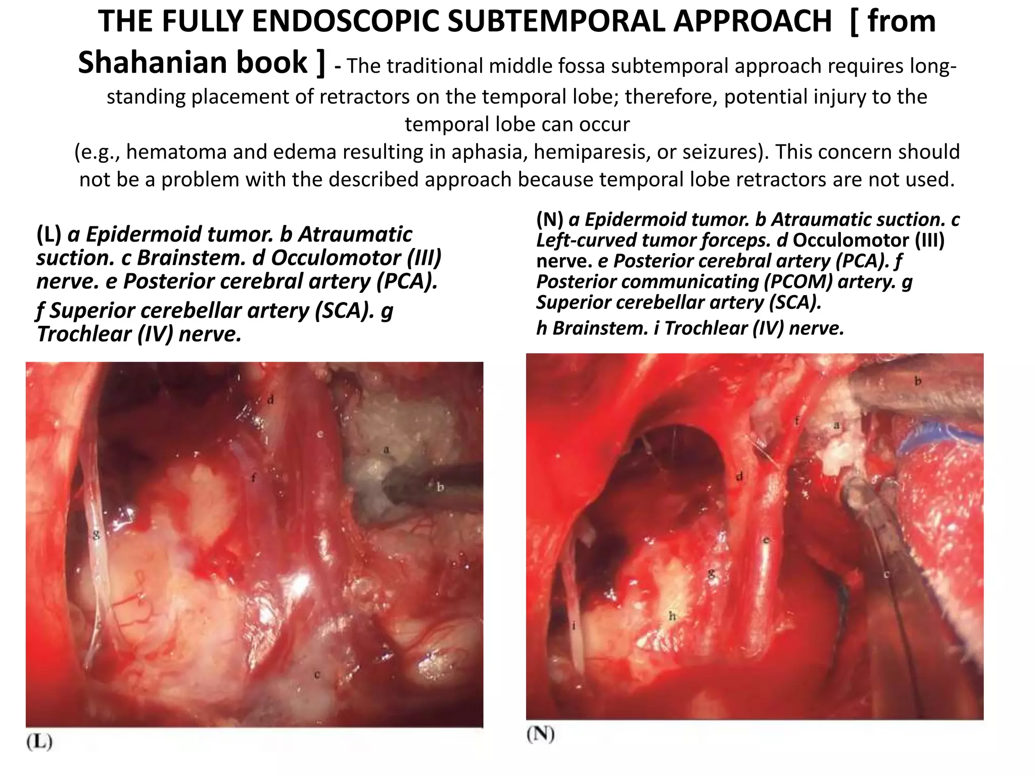 THE FULLY ENDOSCOPIC SUBTEMPORAL APPROACH [ from
Shahanian book ] - The traditional middle fossa subtemporal approach requires long-
standing placement of retractors on the temporal lobe; therefore, potential injury to the
temporal lobe can occur
(e.g., hematoma and edema resulting in aphasia, hemiparesis, or seizures). This concern should
not be a problem with the described approach because temporal lobe retractors are not used.
(L) a Epidermoid tumor. b Atraumatic
suction. c Brainstem. d Occulomotor (III)
nerve. e Posterior cerebral artery (PCA).
f Superior cerebellar artery (SCA). g
Trochlear (IV) nerve.
(N) a Epidermoid tumor. b Atraumatic suction. c
Left-curved tumor forceps. d Occulomotor (III)
nerve. e Posterior cerebral artery (PCA). f
Posterior communicating (PCOM) artery. g
Superior cerebellar artery (SCA).
h Brainstem. i Trochlear (IV) nerve.
 