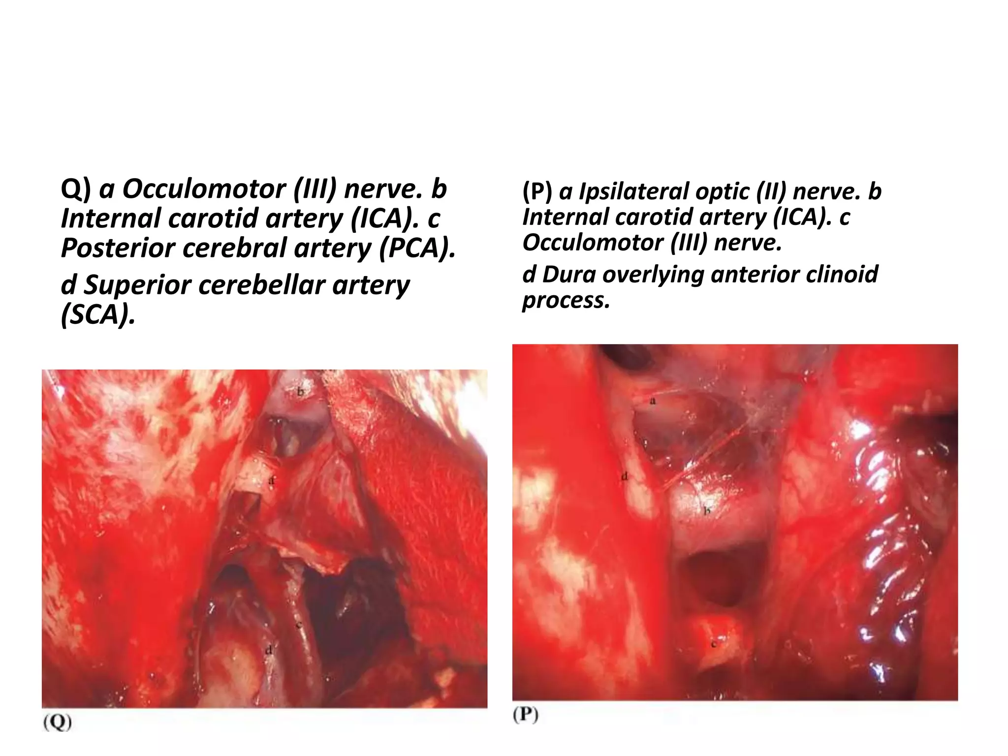 Q) a Occulomotor (III) nerve. b
Internal carotid artery (ICA). c
Posterior cerebral artery (PCA).
d Superior cerebellar artery
(SCA).
(P) a Ipsilateral optic (II) nerve. b
Internal carotid artery (ICA). c
Occulomotor (III) nerve.
d Dura overlying anterior clinoid
process.
 