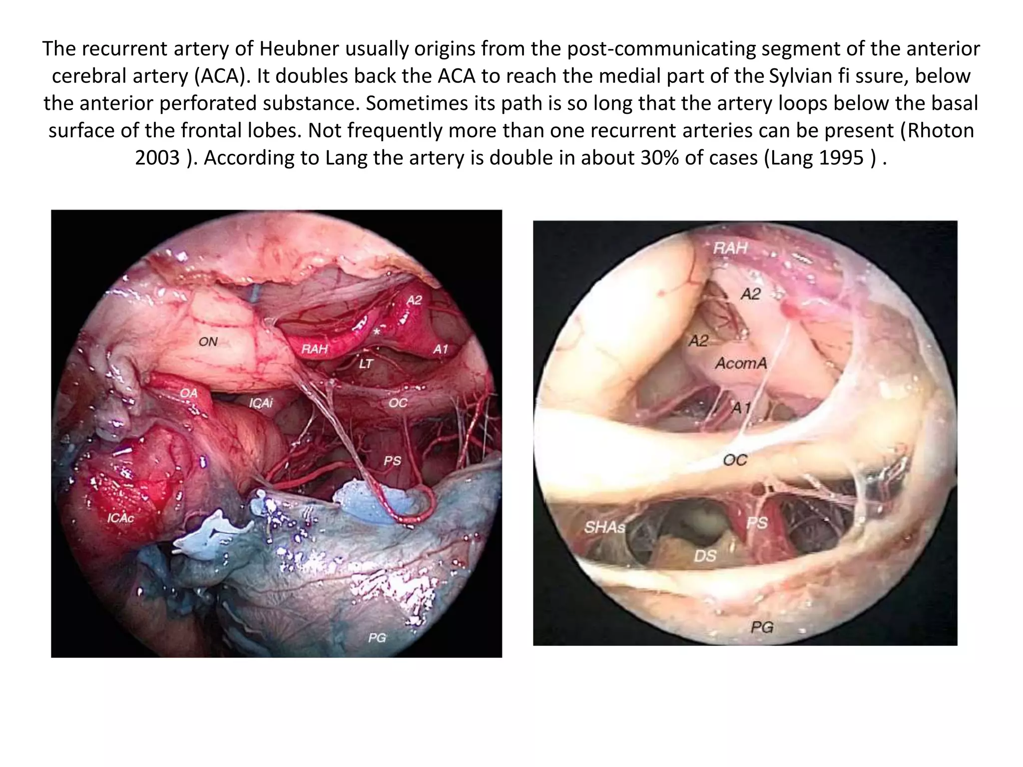 The recurrent artery of Heubner usually origins from the post-communicating segment of the anterior
cerebral artery (ACA). It doubles back the ACA to reach the medial part of the Sylvian fi ssure, below
the anterior perforated substance. Sometimes its path is so long that the artery loops below the basal
surface of the frontal lobes. Not frequently more than one recurrent arteries can be present (Rhoton
2003 ). According to Lang the artery is double in about 30% of cases (Lang 1995 ) .
 