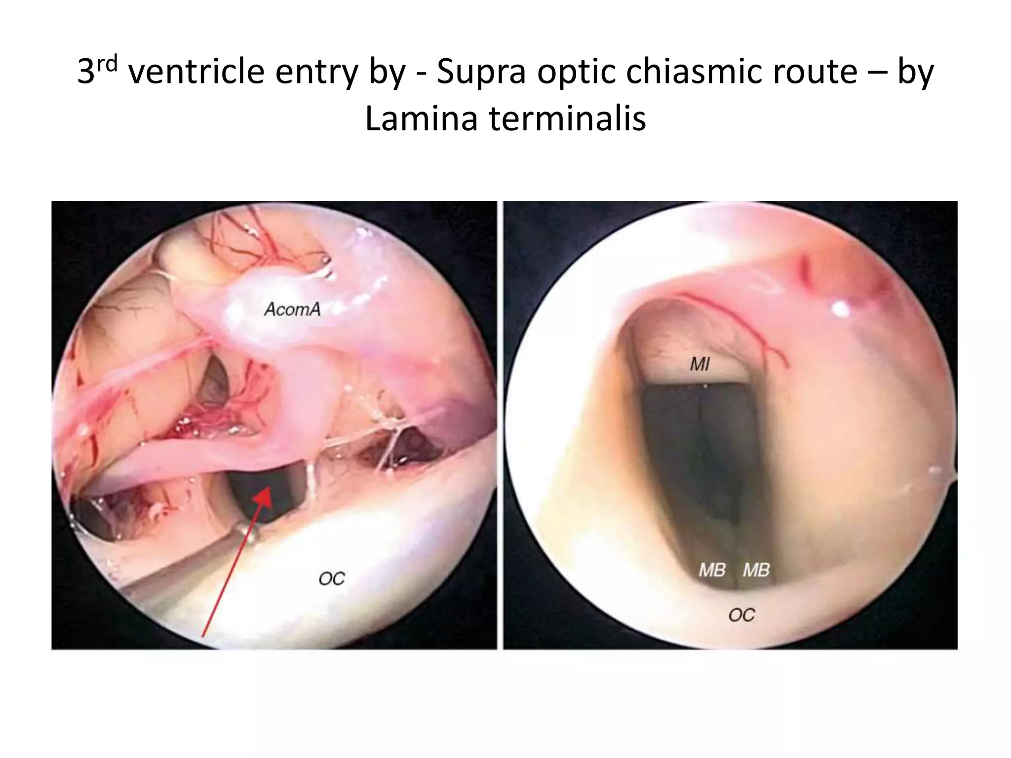 3rd ventricle entry by - Supra optic chiasmic route – by
Lamina terminalis
 