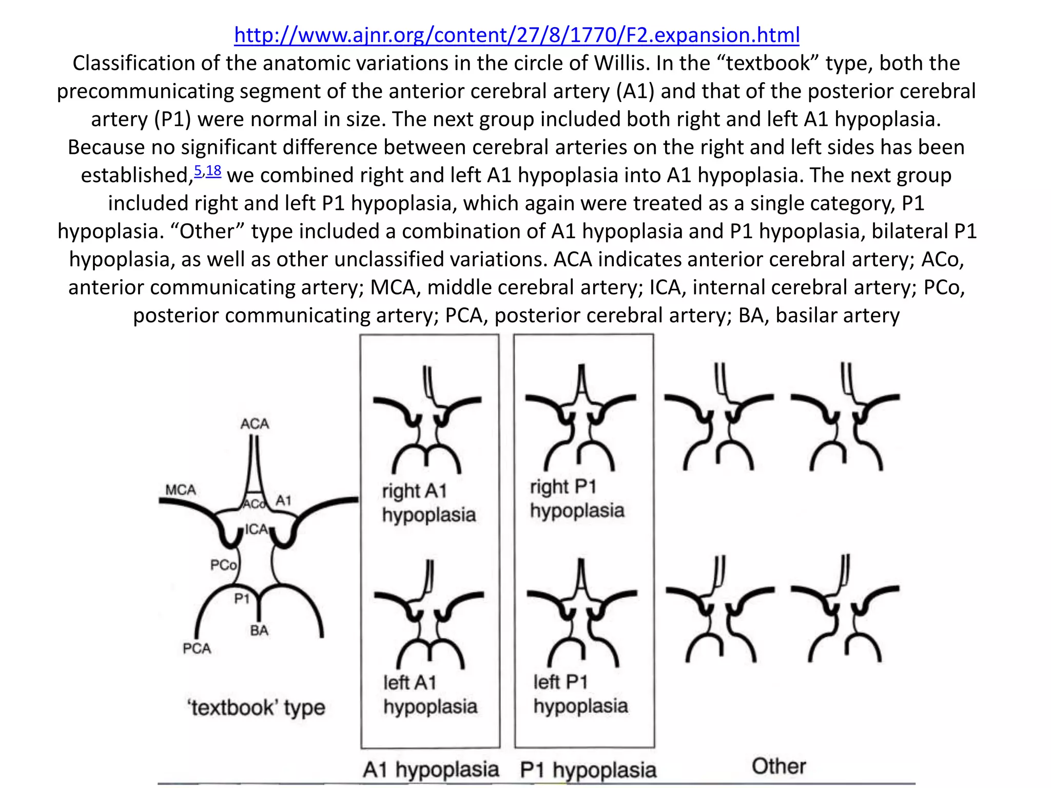 http://www.ajnr.org/content/27/8/1770/F2.expansion.html
Classification of the anatomic variations in the circle of Willis. In the “textbook” type, both the
precommunicating segment of the anterior cerebral artery (A1) and that of the posterior cerebral
artery (P1) were normal in size. The next group included both right and left A1 hypoplasia.
Because no significant difference between cerebral arteries on the right and left sides has been
established,5,18 we combined right and left A1 hypoplasia into A1 hypoplasia. The next group
included right and left P1 hypoplasia, which again were treated as a single category, P1
hypoplasia. “Other” type included a combination of A1 hypoplasia and P1 hypoplasia, bilateral P1
hypoplasia, as well as other unclassified variations. ACA indicates anterior cerebral artery; ACo,
anterior communicating artery; MCA, middle cerebral artery; ICA, internal cerebral artery; PCo,
posterior communicating artery; PCA, posterior cerebral artery; BA, basilar artery
 