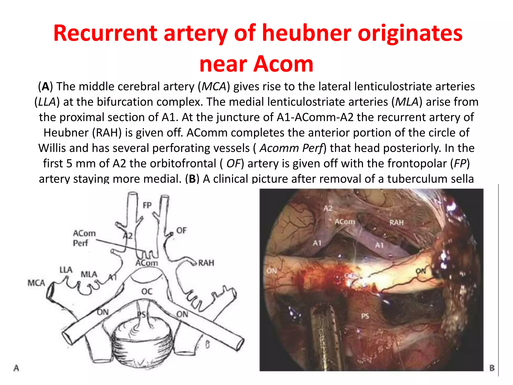 Recurrent artery of heubner originates
near Acom
(A) The middle cerebral artery (MCA) gives rise to the lateral lenticulostriate arteries
(LLA) at the bifurcation complex. The medial lenticulostriate arteries (MLA) arise from
the proximal section of A1. At the juncture of A1-AComm-A2 the recurrent artery of
Heubner (RAH) is given off. AComm completes the anterior portion of the circle of
Willis and has several perforating vessels ( Acomm Perf) that head posteriorly. In the
first 5 mm of A2 the orbitofrontal ( OF) artery is given off with the frontopolar (FP)
artery staying more medial. (B) A clinical picture after removal of a tuberculum sella
meningioma with a well-defined display of the anterior cerebral arteries.
 