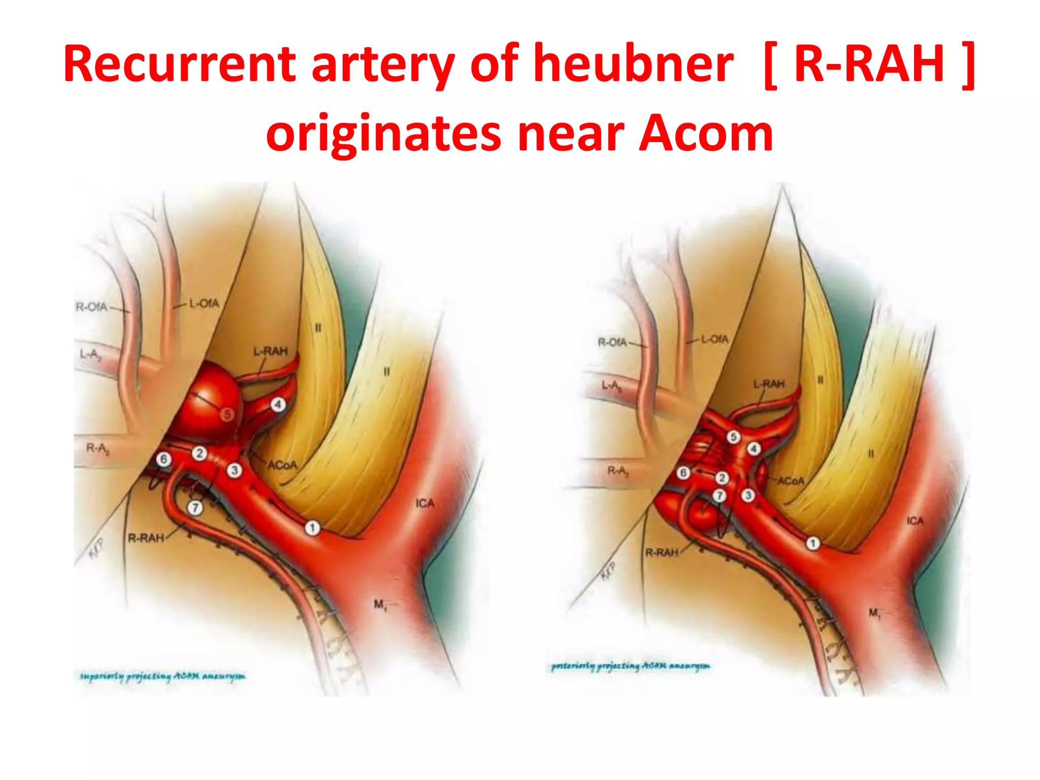 Recurrent artery of heubner [ R-RAH ]
originates near Acom
 