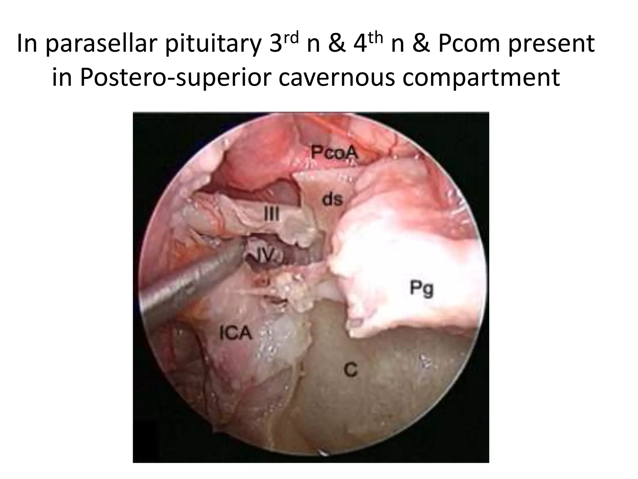 In parasellar pituitary 3rd n & 4th n & Pcom present
in Postero-superior cavernous compartment
 