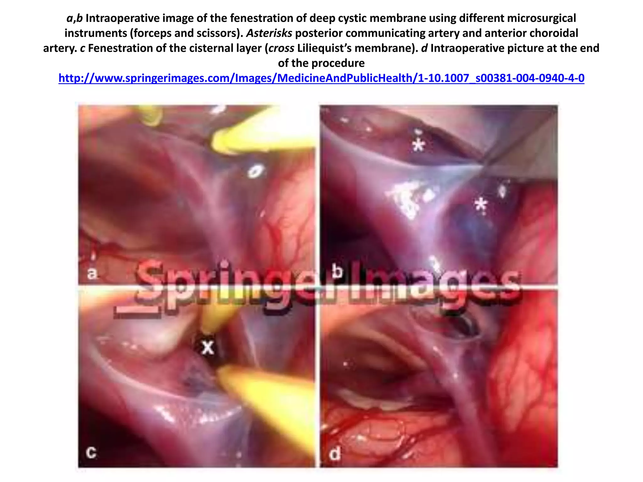 a,b Intraoperative image of the fenestration of deep cystic membrane using different microsurgical
instruments (forceps and scissors). Asterisks posterior communicating artery and anterior choroidal
artery. c Fenestration of the cisternal layer (cross Liliequist’s membrane). d Intraoperative picture at the end
of the procedure
http://www.springerimages.com/Images/MedicineAndPublicHealth/1-10.1007_s00381-004-0940-4-0
 