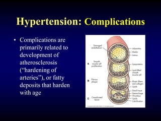 Hypertension: Complications
• Complications are
primarily related to
development of
atherosclerosis
(“hardening of
arteries”), or fatty
deposits that harden
with age
 