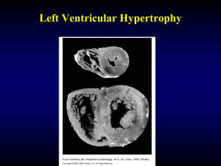 Left Ventricular Hypertrophy
 