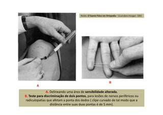A. Delineando uma área de sensibilidade alterada.
B. Teste para discriminação de dois pontos, para lesões de nervos periféricos ou
radiculopatias que afetam a ponta dos dedos ( clipe curvado de tal modo que a
distância entre suas duas pontas é de 5 mm).
A
B
Reider, O Exame Físico em Ortopedia – Guanabara Koogan -2001
 