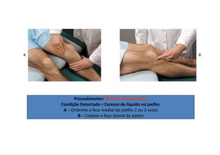 Procedimento= Sinal do abaulamento
Condição Detectada = Excesso de líquido no joelho
A – Ordenhe a face medial do joelho 2 ou 3 vezes
B – Colpeie a face lateral da patela
 