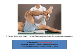 Procedimento = Teste de McMurray
Condição Detectada = Ruptura do menisco do joelho
O Joelho é flexionado após a rotação medial da perna.
 