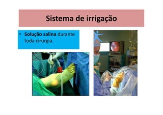 Sistema de irrigação
• Solução salina durante
toda cirurgia.
 