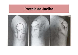 Portais do Joelho
 