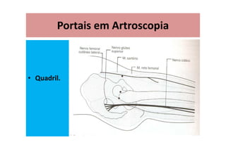 Portais em Artroscopia
• Quadril.
 