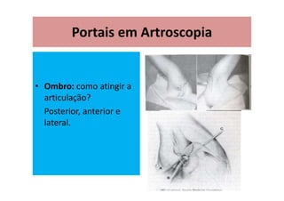 Portais em Artroscopia
• Ombro: como atingir a
articulação?
Posterior, anterior e
lateral.
 
