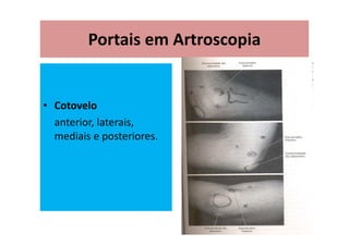 Portais em Artroscopia
• Cotovelo
anterior, laterais,
mediais e posteriores.
 