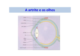 A artrite e os olhos
 