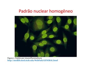 Padrão nuclear homogêneo
Figura 2. Padrão por imunofluorescência
http://medlib.med.utah.edu/WebPath/GENERAL.html
 