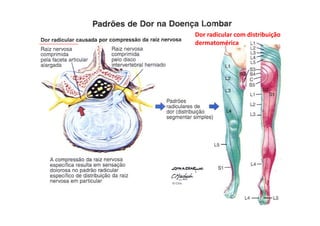 figura
Dor radicular com distribuição
dermatomérica
 