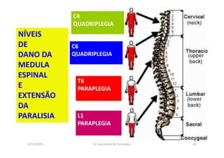 07/12/2015 Dr. José Heitor M. Fernandes 69
C4
QUADRIPLEGIA
C6
QUADRIPLEGIA
T6
PARAPLEGIA
L1
PARAPLEGIA
NÍVEIS
DE
DANO DA
MEDULA
ESPINAL
E
EXTENSÃO
DA
PARALISIA
 