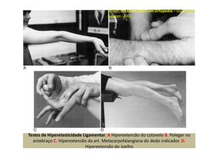 Testes de Hiperelasticidade Ligamentar. A Hiperextensão do cotovelo B. Polegar no
antebraço C. Hiperextensão da art. Metacarpofalangiana do dedo indicador. D.
Hiperextensão do Joelho
Reider, O Exame Físico em Ortopedia – Guanabara
Koogan -2001
 