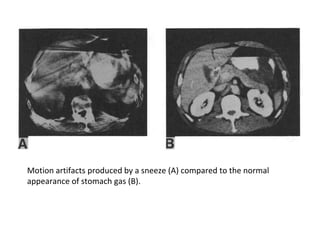 Motion artifacts produced by a sneeze (A) compared to the normal
appearance of stomach gas (B).
 