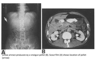Streak artifact produced by a shotgun pellet (B). Scout film (A) shows location of pellet
(arrow)
 
