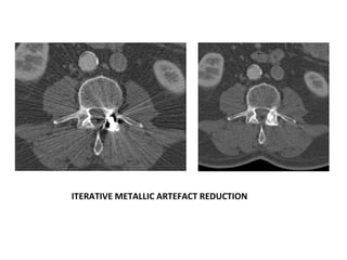 ITERATIVE METALLIC ARTEFACT REDUCTION
 