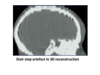 Stair step artefact in 3D reconstruction
 