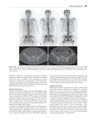 Skeletal Scintigraphy 107 
A B C 
D E 
Figure 7-14. Flare phenomena on bone scan (A to C). A, Metastatic lesions in a patient with breast cancer appear to progress during therapy on (B) 
bone scan 4 months later. However, marked improvement is seen (C) on a scan after 6 months. Pelvic CT images (D,E) obtained at the time of the first 
bone scan (D) show lytic lesions initially but fairly diffuse sclerosis on a follow-up CT (E) performed after the third bone scan, corresponding to treat-ment 
than 5% of the time. The incidence increases to 10% in 
stage II and 20% in stage III disease. In patients with PSA 
levels less than 10 ng/mL, bone metastases are rarely 
found (<1% of the time). Scintigraphy is still indicated to 
evaluate symptomatic patients and suspicious areas seen 
radiographically. With increasing PSA levels, the chance of 
detecting metastatic disease increases. 
Breast Carcinoma 
Despite increased screening with mammography, a large 
number of patients with breast cancer are initially diag-nosed 
with advanced disease. Autopsy studies have shown 
osseous metastases in 50% to 80% of patients with breast 
carcinoma. Like prostate cancer, stage of disease correlates 
with the incidence of osseous metastases on bone scan— 
0.5% in stage I, 2% to 3% in stage II, 8% in stage III, and 
13% in stage IV. Bone scans are not generally performed in 
patients with stage I or II disease. 
Skeletal scintigraphy is highly sensitive in breast cancer. 
Patients may show local invasion of the ribs or sternum or 
disseminated disease. Although activity in the sternum is 
most often benign, a high incidence of metastatic disease is 
seen in patients with breast cancer (>75%-80%). Abnormal 
soft tissue activity can be seen from tumor or surgery in the 
breast, in disease that is metastatic the liver (Fig. 7-16), and 
in malignant pleural effusions. F-18 FDG PET comple-ments 
bone scan, detecting lytic lesions and those in mar-row, 
but showing lower sensitivity for blastic lesions. 
Lung Carcinoma 
Although up to 50% of patients dying from a primary lung 
cancer have osseous metastasis at autopsy, no complete 
agreement exists on when to use skeletal scintigraphy. 
Staging is generally done with CT, surgery (including medi-astinoscopy 
and video-assisted thoracoscopic surgery), and 
increasingly F-18 FDG PET. Skeletal scintigraphy is useful 
in a patient who develops pain during or after treatment. 
Interesting patterns of disease may occur on scintigrams 
in lung cancer. Because these tumors can easily invade the 
vasculature, arterial metastases are more common. These 
tumor emboli can reach the distal extremities. Thus 
appendicular involvement is more common with aggres-sive 
lung cancer than cancer of the breast or prostate. Also, 
increased cortical activity, prominent in the extremities, 
can be seen in lung cancer as a result of hypertrophic 
osteoarthropathy (Figs. 7-17 and 7-18). 
response. 
 