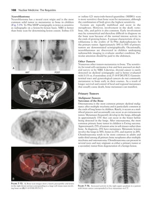 108 Nuclear Medicine: The Requisites 
Neuroblastoma 
Neuroblastoma has a neural crest origin and is the most 
common solid tumor to metastasize to bone in children 
(Fig. 7-19). Tc-99m MDP scintigraphy is twice as sensitive 
as radiographs on a lesion-by-lesion basis. MRI is better 
than bone scan for determining lesion extent. Iodine-131 
or iodine-123 meta-iodo-benzyl-guanidine (MIBG) scan 
is more sensitive than bone scan for metastases, although 
the combination of both gives the highest sensitivity. 
Lesions are typically multifocal and occur in the 
metaphyses. However, involvement in the skull, verte-brae, 
ribs, and pelvis is also common. Early involvement 
may be symmetrical and therefore difficult to diagnose on 
the bone scan because of the normal intense activity in 
the ends of growing bones. A unique characteristic of neu-roblastoma 
is the avidity of Tc-99m diphosphonates for 
the primary tumor. Approximately 30% to 50% of primary 
tumors are demonstrated scintigraphically. Occasionally, 
neuroblastomas are discovered in children undergoing 
radionuclide imaging to evaluate another condition. Par-ticular 
attention should be paid to the abdomen. 
Other Tumors 
Numerous other tumors metastasize to bone. The sensitiv-ity 
for renal cell carcinoma is low and best assessed on skel-etal 
survey or by MRI. Likewise, thyroid cancer is rarely 
detected on skeletal scintigraphy and is better evaluated 
with I-131 or, if noniodine avid, F-18 FDG PET. Gastroin-testinal 
tract and gynecological cancers do not commonly 
metastasize to bone early in their courses. As a result of 
longer survival and control of local and regional metastases 
that usually cause death, bone metastases can manifest. 
Primary Tumors 
Malignant Tumors 
Sarcomas of the Bone 
Osteosarcoma is the most common primary skeletal malig-nancy 
after multiple myeloma and is particularly common at 
the ends of long bones in children. Rarely, it occurs as a mul-tifocal 
process and occasionally can occur as an extraosseous 
tumor. Metastases frequently develop in the lungs, although 
in approximately 15% they can occur in the bones before 
being detected in the lungs. After osteosarcoma, the most 
common primary bone tumor in children is Ewing sarcoma. 
Approximately 25% of tumors arise in soft tissues rather than 
bone. At diagnosis, 25% have metastases. Metastatic lesions 
involve the lungs in 50%, bones in 25%, and marrow in 20%. 
Chondrosarcoma tends to be more common in adults and 
ranks third among all primary bone neoplasms after multiple 
myeloma and osteosarcoma. Chondrosarcoma can present in 
several ways and may originate as either a primary tumor or 
a secondary tumor from degeneration of a benign lesion. 
ANT POST 
A 
B 
Figure 7-15. A, Bone scan images show a barely perceptible cold lesion 
in the right ileum (arrow) corresponding to a large soft tissue mass involv-ing 
bone on (B) F-18 FDG PET-CT. 
Figure 7-16. Increased activity in the right upper quadrant in a patient 
with breast cancer corresponded to liver metastases on CT. 
 
