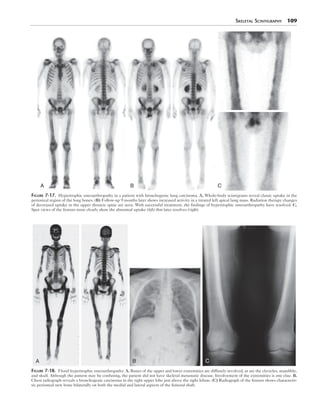 Skeletal Scintigraphy 109 
A B C 
Figure 7-17. Hypertrophic osteoarthropathy in a patient with bronchogenic lung carcinoma. A, Whole-body scintigrams reveal classic uptake in the 
periosteal region of the long bones. (B) Follow-up 9 months later shows increased activity in a treated left apical lung mass. Radiation therapy changes 
of decreased uptake in the upper thoracic spine are seen. With successful treatment, the findings of hypertrophic osteoarthropathy have resolved. C, 
Spot views of the femurs more clearly show the abnormal uptake (left) that later resolves (right). 
A B C 
Figure 7-18. Florid hypertrophic osteoarthropathy. A, Bones of the upper and lower extremities are diffusely involved, as are the clavicles, mandible, 
and skull. Although the pattern may be confusing, the patient did not have skeletal metastatic disease. Involvement of the extremities is one clue. B, 
Chest radiograph reveals a bronchogenic carcinoma in the right upper lobe just above the right hilum. (C) Radiograph of the femurs shows characteris-tic 
periosteal new bone bilaterally on both the medial and lateral aspects of the femoral shaft. 
 