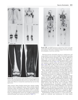 Skeletal Scintigraphy 111 
other reasons. Some benign tumors have intense uptake 
similar to that in malignant tumors. These include osteoid 
osteomas, giant cell tumors, and fibrous dysplasia. Other 
tumors may show a characteristic pattern such as a periph-eral 
rim of activity around a cold central area in aneurismal 
bone cyst. Benign bone tumors are variable in appearance; 
selected benign bone tumors are listed in Table 7-3. 
Osteoid osteoma classically presents in adolescents and 
young adults as severe pain at night. Commonly occurring 
in the proximal femur and spine, they may be difficult to 
detect with conventional radiography. The diagnosis on 
radiographs can be made if a central lucent nidus is seen 
surrounded by sclerosis (Fig. 7-23). Skeletal scintigraphy is 
very sensitive, and the lesion will show increased uptake 
(Fig. 7-24). SPECT adds to this sensitivity and is particu-larly 
useful in the spine. Surgeons can use an intraoperative 
probe to localize the lesion with its increased activity. How-ever, 
CT has largely eliminated the need for the bone scan. 
Bone islands rarely accumulate Tc-99m MDP, so bone 
scan may be useful in assessing an atypical bone island on 
radiographs. If the sclerotic lesion on radiograph does not 
show increased activity, it is unlikely to be malignant. 
Osteochondromas, common cartilage-containing benign 
tumors, may show variable uptake that diminishes as the 
skeleton matures. Rarely, osteochondromas will show malig-nant 
transformation, usually into a chondrosarcoma. This 
degeneration occurs less than 1% of the time in a solitary 
lesion and less than 5% of the time in hereditary multi-ple 
osteochondromatosis (hereditary multiple exostoses). 
Although bone scan can exclude malignancy if no increased 
uptake is seen, the presence of increased activity does not 
differentiate benign from malignant lesions. Any new uptake 
in a lesion that previously had none is suspicious. Osteo-chondromas 
are usually best evaluated with CT and MRI. 
Enchondromas usually present as a cystic lesion in the 
hands or a sclerotic area reminiscent of a bone infarct 
A 
B 
Figure 7-21. A, Osteosarcoma of the left distal femur and a metastatic 
lesion in the left proximal femur. B, Coronal T1-weighted MRI reveals 
superior anatomical information about the osseous and soft tissue extent 
of the tumor. However, it missed the second lesion that was out of the 
field of view. 
A B 
Figure 7-22. A and B, Extraosseous osteosarcoma arising in the right 
medial thigh with widely disseminated skeletal, soft tissue, and pulmo-nary 
metastases. This study is a dramatic example of the ability of skel-etal 
scintigraphy to survey the entire body. 
 