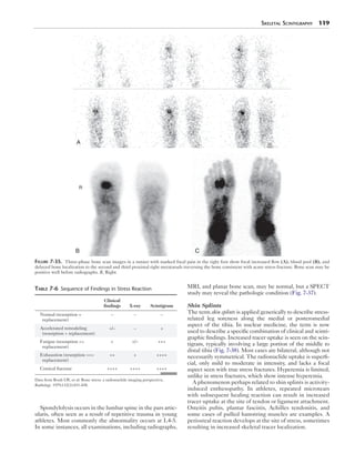 Skeletal Scintigraphy 119 
R 
Spondylolysis occurs in the lumbar spine in the pars artic-ularis, 
often seen as a result of repetitive trauma in young 
athletes. Most commonly the abnormality occurs at L4-5. 
In some instances, all examinations, including radiographs, 
MRI, and planar bone scan, may be normal, but a SPECT 
study may reveal the pathologic condition (Fig. 7-37). 
Shin Splints 
The term shin splints is applied generically to describe stress-related 
leg soreness along the medial or posteromedial 
aspect of the tibia. In nuclear medicine, the term is now 
used to describe a specific combination of clinical and scinti-graphic 
findings. Increased tracer uptake is seen on the scin-tigram, 
typically involving a large portion of the middle to 
distal tibia (Fig. 7-38). Most cases are bilateral, although not 
necessarily symmetrical. The radionuclide uptake is superfi-cial, 
only mild to moderate in intensity, and lacks a focal 
aspect seen with true stress fractures. Hyperemia is limited, 
unlike in stress fractures, which show intense hyperemia. 
A phenomenon perhaps related to shin splints is activ­ity-induced 
enthesopathy. In athletes, repeated microtears 
with subsequent healing reaction can result in increased 
tracer uptake at the site of tendon or ligament attachment. 
Osteitis pubis, plantar fasciitis, Achilles tendonitis, and 
some cases of pulled hamstring muscles are examples. A 
periosteal reaction develops at the site of stress, sometimes 
resulting in increased skeletal tracer localization. 
A 
B 
C 
Figure 7-35. Three-phase bone scan images in a runner with marked focal pain in the right foot show focal increased flow (A), blood pool (B), and 
delayed bone localization to the second and third proximal right metatarsals traversing the bone consistent with acute stress fracture. Bone scan may be 
positive well before radiographs. R, Right. 
Table 7-6 Sequence of Findings in Stress Reaction 
Clinical 
findings X-ray Scintigram 
Normal (resorption = 
replacement) 
– – – 
Accelerated remodeling 
(resorption > replacement) 
+/– – + 
Fatigue (resorption >> 
replacement) 
+ +/– +++ 
Exhaustion (resorption >>> 
replacement) 
++ + ++++ 
Cortical fracture ++++ ++++ ++++ 
Data from Roub LW, et al: Bone stress: a radionuclide imaging perspective, 
Radiology. 1979;132(2):431-438. 
 