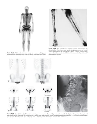 Figure 7-36. Whole-body bone scan images in a runner with leg pain 
reveal a fusiform, superficial lesion in the left medial femur from stress injury. 
ANT POST 
Figure 7-38. Shin splint. Lateral views of a patient demonstrating the 
classic finding of increased tracer uptake along the posterior and medial 
aspects of the tibia on the left (left side of image). A similar pattern can be 
seen on the right, but with the addition of a focal area distally, which could 
indicate stress fracture. 
Transverse 
B C 
Coronal 
A 
Figure 7-37. Spondylolysis. (A) Planar bone scan images are normal in a 20-year-old gymnast with severe low back pain and negative radiographs and 
MRI. (B) However, transverse and coronal SPECT images show focal abnormal activity in the right posterior elements of L5-S1 (arrow) consistent with 
spondylolysis. (C) Oblique LS spine radiograph from a different patient shows a pars interarticularis defect at L5. 
 