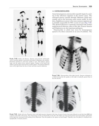Skeletal Scintigraphy 123 
OSTEOMYELITIS 
Acute hematogenous osteomyelitis typically begins by seed-ing 
of the infectious organism in the marrow space. The 
untreated process extends through Volkmann canals hori-zontally 
and in the haversian canal system axially. In chil-dren, 
Staphylococcus aureus is the most common organism and 
is probably responsible for 50% or more of cases (Fig. 7-44). 
The skeletal infection is commonly associated with another 
staphylococcal infection, often of the skin. Enteric bacteria 
and Streptococcus are also important pathogens. 
Osteomyelitis in adults may occur by hematogenous 
spread or by direct extension in an area of cellulitis. The 
A B 
Figure 7-43. Sickle cell crisis. Posterior views with high intensity obtained at the time of onset of acute chest pain (A) and several days later (B) from 
a patient with sickle cell anemia. The initial image reveals no abnormality in the ribs. The follow-up image demonstrates increased uptake, particularly 
in the right ribs, associated with healing of the infarctions. Note the uptake in the spleen on both images. Typically, once the spleen is visualized scin-tigraphically, 
it remains positive. 
Figure 7-44. Osteomyelitis of the right clavicle. Anterior scintigram in 
a child showing that the uptake on the right is markedly greater than in 
the left clavicle. 
Figure 7-42. Sickle cell disease. Anterior and posterior whole-body 
views. Calvarial uptake is increased with relative thinning at the midline. 
Prominent skeleton to soft tissue uptake is seen. The kidneys appear 
large, and the spleen shows intense uptake. Uptake in the knees and 
ankles is greater than expected for an adult subject. The photon-­deficient 
areas in the right femur are due to bone and bone marrow infarction. 
 