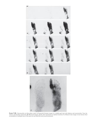 A 
B 
C 
Figure 7-45. Osteomyelitis on three-phase study. A, Sequential dynamic images in a middle-aged man with diabetes and osteomyelitis. Note the 
intense arterial phase hyperemia. B, Blood pool images already show localization in skeletal structures. C, Delayed static images reveal intense focal 
accumulation in multiple areas of the great toe and distal first and second metatarsals. 
 