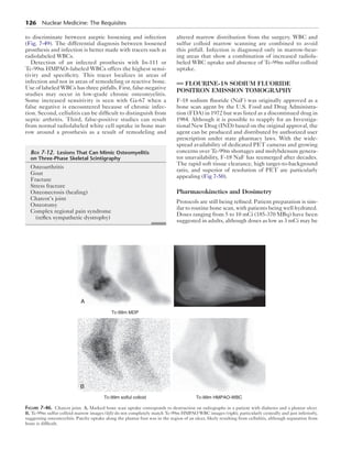 126 Nuclear Medicine: The Requisites 
to discriminate between aseptic loosening and infection 
(Fig. 7-49). The differential diagnosis between loosened 
prosthesis and infection is better made with tracers such as 
radiolabeled WBCs. 
Detection of an infected prosthesis with In-111 or 
­Tc- 
99m HMPAO–labeled WBCs offers the highest sensi-tivity 
and specificity. This tracer localizes in areas of 
infection and not in areas of remodeling or reactive bone. 
Use of labeled WBCs has three pitfalls. First, false-nega­tive 
studies may occur in low-grade chronic osteomyelitis. 
Some increased sensitivity is seen with Ga-67 when a 
false negative is encountered because of chronic infec-tion. 
Second, cellulitis can be difficult to distinguish from 
septic arthritis. Third, false-positive studies can result 
from normal radiolabeled white cell uptake in bone mar-row 
around a prosthesis as a result of remodeling and 
altered marrow distribution from the surgery. WBC and 
sulfur colloid marrow scanning are combined to avoid 
this pitfall. Infection is diagnosed only in marrow-bear-ing 
areas that show a combination of increased radiola-beled 
WBC uptake and absence of Tc-99m sulfur colloid 
uptake. 
FLOURINE-18 SODIUM FLUORIDE 
POSITRON EMISSION TOMOGRAPHY 
F-18 sodium fluoride (NaF) was originally approved as a 
bone scan agent by the U.S. Food and Drug Administra-tion 
(FDA) in 1972 but was listed as a discontinued drug in 
1984. Although it is possible to reapply for an Investiga-tional 
New Drug (IND) based on the original approval, the 
agent can be produced and distributed by authorized user 
prescription under state pharmacy laws. With the wide-spread 
availability of dedicated PET cameras and growing 
concerns over Tc-99m shortages and molybdenum genera-tor 
unavailability, F-18 NaF has reemerged after decades. 
The rapid soft tissue clearance, high target-to-background 
ratio, and superior of resolution of PET are particularly 
appealing (Fig 7-50). 
Pharmacokinetics and Dosimetry 
Protocols are still being refined. Patient preparation is sim-ilar 
to routine bone scan, with patients being well hydrated. 
Doses ranging from 5 to 10 mCi (185-370 MBq) have been 
suggested in adults, although doses as low as 3 mCi may be 
Box 7-12. Lesions That Can Mimic Osteomyelitis 
on Three-Phase Skeletal Scintigraphy 
Osteoarthritis 
Gout 
Fracture 
Stress fracture 
Osteonecrosis (healing) 
Charcot’s joint 
Osteotomy 
Complex regional pain syndrome 
(reflex sympathetic dystrophy) 
Tc-99m MDP 
Tc-99m solful colloid Tc-99m HMPAO-WBC 
A 
B 
Figure 7-46. Charcot joint. A, Marked bone scan uptake corresponds to destruction on radiographs in a patient with diabetes and a plantar ulcer. 
B, Tc-99m sulfur colloid marrow images (left) do not completely match Tc-99m HMPAO WBC images (right), particularly centrally and just inferiorly, 
suggesting osteomyelitis. Patchy uptake along the plantar foot was in the region of an ulcer, likely resulting from cellulitis, although separation from 
bone is difficult. 
 