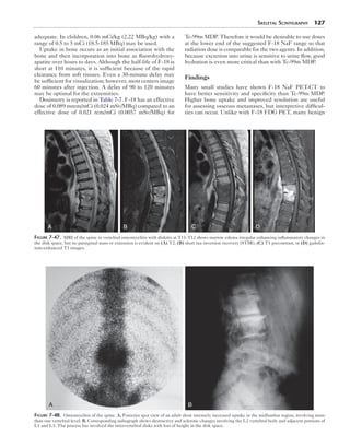 Skeletal Scintigraphy 127 
adequate. In children, 0.06 mCi/kg (2.22 MBq/kg) with a 
range of 0.5 to 5 mCi (18.5-185 MBq) may be used. 
Uptake in bone occurs as an initial association with the 
bone and then incorporation into bone as fluorohydroxy-apatite 
over hours to days. Although the half-life of F-18 is 
short at 110 minutes, it is sufficient because of the rapid 
clearance from soft tissues. Even a 30-minute delay may 
be sufficient for visualization; however, most centers image 
60 minutes after injection. A delay of 90 to 120 minutes 
may be optimal for the extremities. 
Dosimetry is reported in Table 7-7. F-18 has an effective 
dose of 0.089 mrem/mCi (0.024 mSv/MBq) compared to an 
effective dose of 0.021 rem/mCi (0.0057 mSv/MBq) for 
Tc-99m MDP. Therefore it would be desirable to use doses 
at the lower end of the suggested F-18 NaF range so that 
radiation dose is comparable for the two agents. In addition, 
because excretion into urine is sensitive to urine flow, good 
hydration is even more critical than with Tc-99m MDP. 
Findings 
Many small studies have shown F-18 NaF PET-CT to 
have better sensitivity and specificity than Tc-99m MDP. 
Higher bone uptake and improved resolution are useful 
for assessing osseous metastases, but interpretive difficul-ties 
can occur. Unlike with F-18 FDG PET, many benign 
A B C D 
Figure 7-47. MRI of the spine in vertebral osteomyelitis with diskitis at T11-T12 shows marrow edema irregular enhancing inflammatory changes in 
the disk space, but no paraspinal mass or extension is evident on (A) T2, (B) short tau inversion recovery (STIR), (C) T1 precontrast, or (D) gadolin-ium- 
enhanced T1 images. 
A B 
Figure 7-48. Osteomyelitis of the spine. A, Posterior spot view of an adult show intensely increased uptake in the midlumbar region, involving more 
than one vertebral level. B, Corresponding radiograph shows destructive and sclerotic changes involving the L2 vertebral body and adjacent portions of 
L1 and L3. The process has involved the intervertebral disks with loss of height in the disk space. 
 