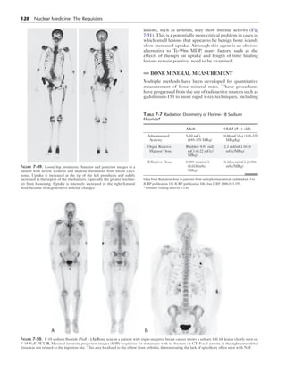128 Nuclear Medicine: The Requisites 
lesions, such as arthritis, may show intense activity (Fig 
7-51). This is a potentially more critical problem in cases in 
which small lesions that appear to be benign bone islands 
show increased uptake. Although this agent is an obvious 
alternative to ­Tc- 
99m MDP, many factors, such as the 
effects of therapy on uptake and length of time healing 
lesions remain positive, need to be examined. 
BONE MINERAL MEASUREMENT 
Multiple methods have been developed for quantitative 
measurement of bone mineral mass. These procedures 
have progressed from the use of radioactive sources such as 
gadolinium-153 to more rapid x-ray techniques, including 
Figure 7-49. Loose hip prosthesis. Anterior and posterior images in a 
patient with severe scoliosis and skeletal metastases from breast carci-noma. 
Uptake is increased at the tip of the left prosthesis and subtly 
increased in the region of the trochanters, especially the greater trochan-ter 
from loosening. Uptake is intensely increased in the right femoral 
head because of degenerative arthritic changes. 
Table 7-7 Radiation Dosimetry of Florine-18 Sodium 
Fluoride* 
Administered 
Activity 
Organ Receive 
Highest Dose 
Effective Dose 0.089 rem/mCi 
Data from Radiation dose to patients from radiopharmaceuticals (addendum 3 to 
ICRP publication 53): ICRP publication 106. Ann ICRP. 2008;38:1-197. 
*Assumes voiding interval 3.5 hr. 
A B 
Adult Child (5 yr old) 
5-10 mCi 
(185-370 MBq) 
0.06 mCi/kg (185-370 
MBq/kg) 
Bladder: 0.81 rad/ 
mCi (0.22 mGy/ 
MBq) 
2.3 rad/mCi (0.61 
mGy/MBq) 
(0.024 mSv/ 
MBq) 
0.32 rem/mCi (0.086 
mSv/MBq) 
Figure 7-50. F-18 sodium fluoride (NaF). (A) Bone scan in a patient with triple-negative breast cancer shows a solitary left rib lesion clearly seen on 
F-18 NaF PET. B, Maximal intensity projection images (MIP) suspicious for metastasis with no fracture on CT. Focal activity in the right antecubital 
fossa was not related to the injection site. This area localized to the elbow from arthritis, demonstrating the lack of specificity often seen with NaF. 
 