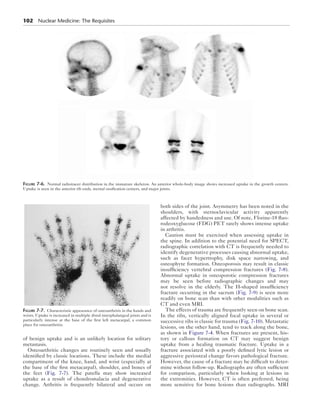 102 Nuclear Medicine: The Requisites 
Figure 7-6. Normal radiotracer distribution in the immature skeleton. An anterior whole-body image shows increased uptake in the growth centers. 
Uptake is seen in the anterior rib ends, sternal ossification centers, and major joints. 
of benign uptake and is an unlikely location for solitary 
metastasis. 
Osteoarthritic changes are routinely seen and usually 
identified by classic locations. These include the medial 
compartment of the knee, hand, and wrist (especially at 
the base of the first metacarpal), shoulder, and bones of 
the feet (Fig. 7-7). The patella may show increased 
uptake as a result of chondromalacia and degenerative 
change. Arthritis is frequently bilateral and occurs on 
both sides of the joint. Asymmetry has been noted in the 
shoulders, with sternoclavicular activity apparently 
affected by handedness and use. Of note, Florine-18 fluo-rodeoxyglucose 
(FDG) PET rarely shows intense uptake 
in arthritis. 
Caution must be exercised when assessing uptake in 
the spine. In addition to the potential need for SPECT, 
radiographic correlation with CT is frequently needed to 
identify degenerative processes causing abnormal uptake, 
such as facet hypertrophy, disk space narrowing, and 
osteophyte formation. Osteoporosis may result in classic 
insufficiency vertebral compression fractures (Fig. 7-8). 
Abnormal uptake in osteoporotic compression fractures 
may be seen before radiographic changes and may 
not resolve in the elderly. The H-shaped insufficiency 
fracture occurring in the sacrum (Fig. 7-9) is seen more 
readily on bone scan than with other modalities such as 
CT and even MRI. 
The effects of trauma are frequently seen on bone scan. 
In the ribs, vertically aligned focal uptake in several or 
successive ribs is classic for trauma (Fig. 7-10). Metastatic 
lesions, on the other hand, tend to track along the bone, 
as shown in Figure 7-4. When fractures are present, his-tory 
or callous formation on CT may suggest benign 
uptake from a healing traumatic fracture. Uptake in a 
fracture associated with a poorly defined lytic lesion or 
aggressive periosteal change favors pathological fracture. 
However, the cause of a fracture may be difficult to deter-mine 
without follow-up. Radiographs are often sufficient 
for comparison, particularly when looking at lesions in 
the extremities. However, CT is often preferred, being 
more sensitive for bone lesions than radiographs. MRI 
Figure 7-7. Characteristic appearance of osteoarthritis in the hands and 
wrists. Uptake is increased in multiple distal interphalangeal joints and is 
particularly intense at the base of the first left metacarpal, a common 
place for osteoarthritis. 
 